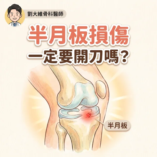 半月板損傷是不是一定要開刀？搞懂「外傷型」與「退化型」，治療選擇大不同