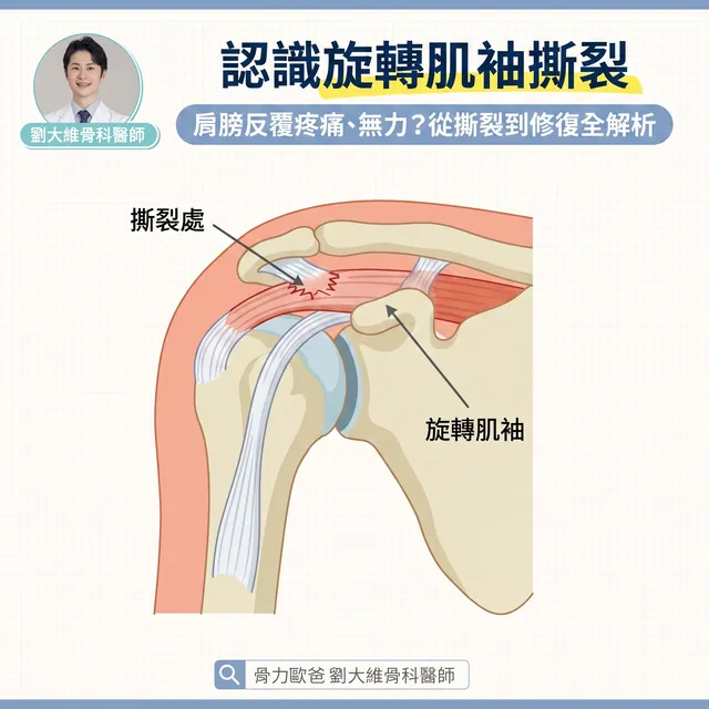 肩膀舉不高、半夜痛醒？當心是「旋轉肌袖撕裂」