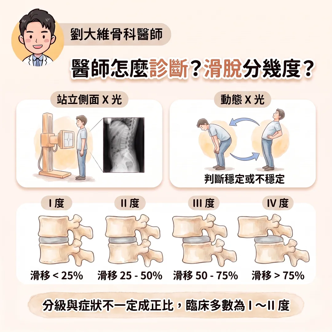 腰椎滑脫症是什麼？為什麼站久走久就腰痠腿麻？醫師教你怎麼預防 衛教圖 7