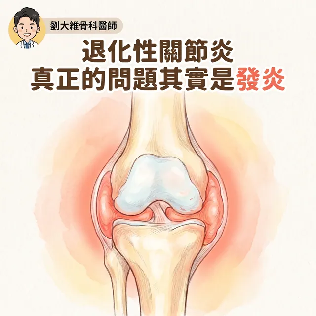 退化性關節炎：或許重點不是退化，而是發炎