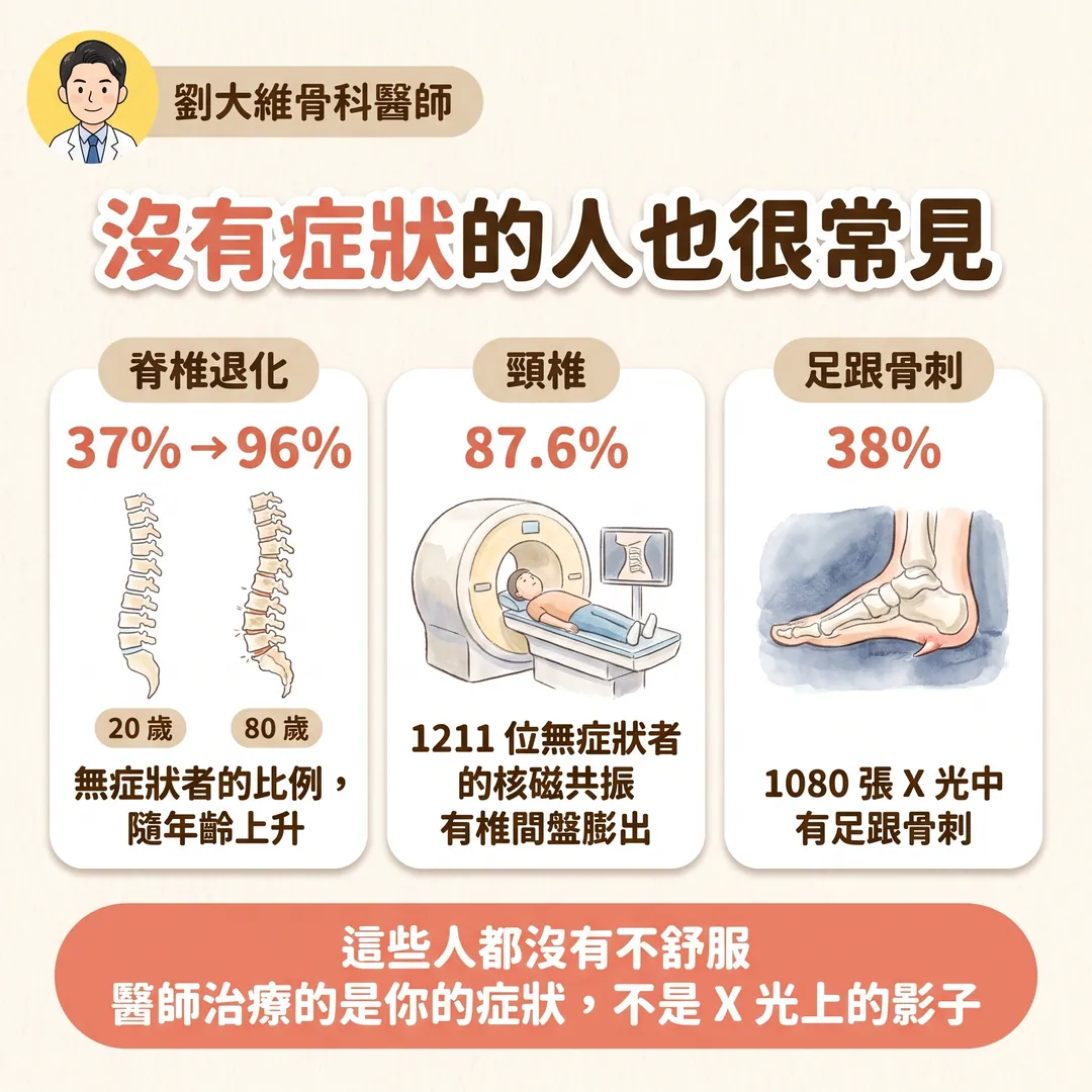 骨刺是什麼？一定要處理嗎？骨科醫師告訴你 衛教圖 3