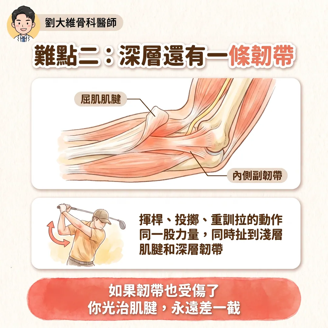 高爾夫球肘（內上髁肌腱病變）：為什麼比網球肘難治 衛教圖 4